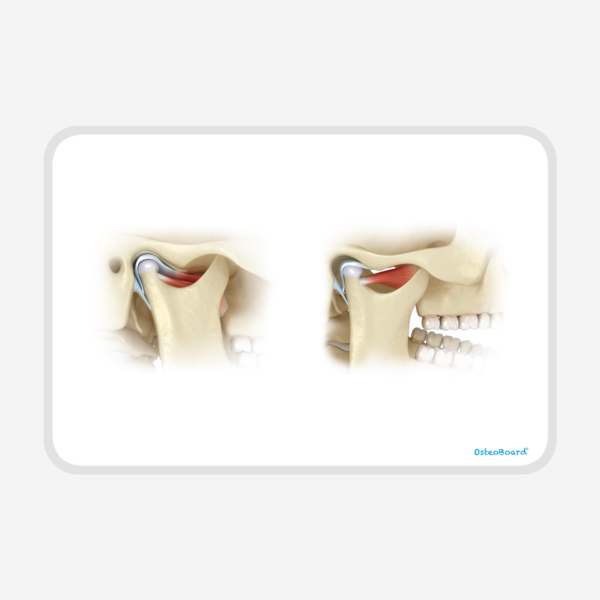 OsteoBoard TMJ